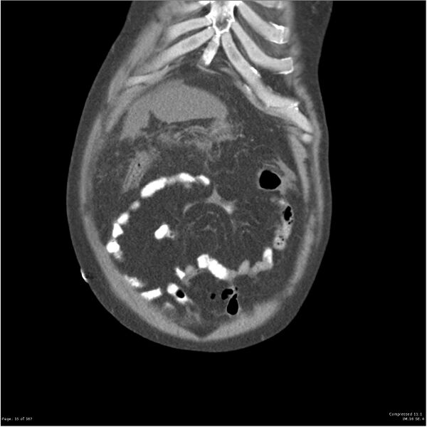 File:Acute pancreatitis (Radiopaedia 19135-19116 Coronal non-contrast 3).jpg