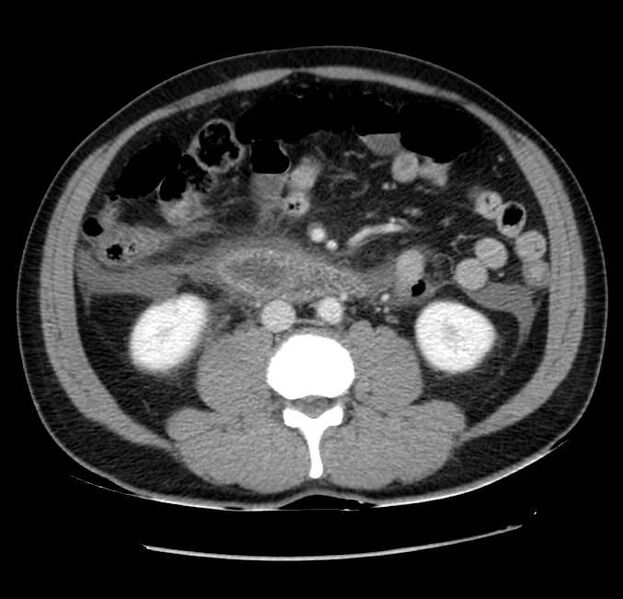 File:Acute pancreatitis - Balthazar E (Radiopaedia 23080-23110 Axial C+ portal venous phase 36).jpg