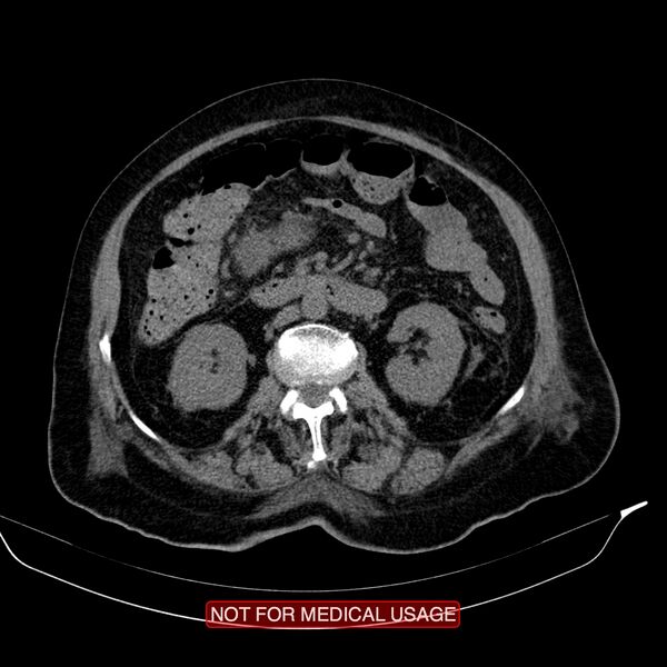File:Acute pancreatitis with infected necrosis (Radiopaedia 26454-26585 Axial non-contrast 16).jpg