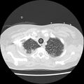 Acute pulmonary edema on CT (Radiopaedia 33582-34672 Axial lung window 6).jpg