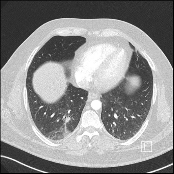 File:Acute pulmonary embolism with pulmonary infarct (Radiopaedia 73062-83768 Axial lung window 12).jpg