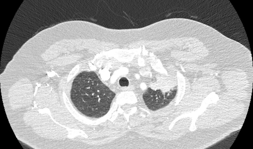 Acute pulmonary embolism with pulmonary infarcts (Radiopaedia 77688-89908 Axial lung window 7).jpg