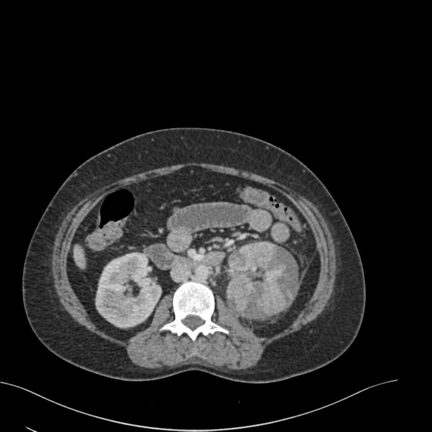 Acute pyelonephritis with renal vein thrombosis (Radiopaedia 58020-65053 Axial renal parenchymal phase 73).jpg