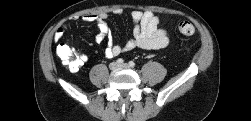Acute sigmoid colon diverticulitis (Radiopaedia 55507-61976 Axial C+ portal venous phase 52).jpg