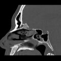 Acute sinusitis (Radiopaedia 23161-23215 Sagittal bone window 33).jpg