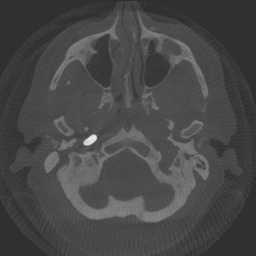 Acute subarachnoid hemorrhage and accessory anterior cerebral artery (Radiopaedia 69231-79010 Axial arterial - MIP 7).jpg