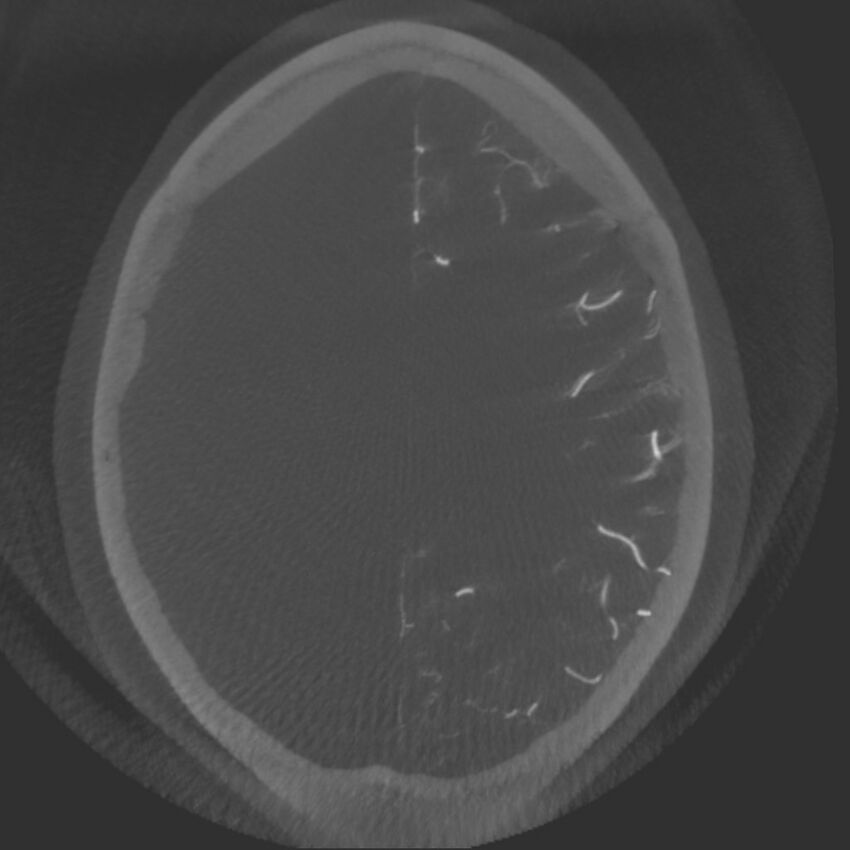 Acute subarachnoid hemorrhage and accessory anterior cerebral artery (Radiopaedia 69231-79010 C 55).jpg