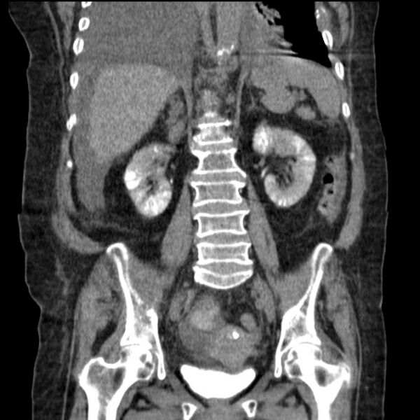 File:Acute tubular necrosis (Radiopaedia 28077-28334 D 54).jpg