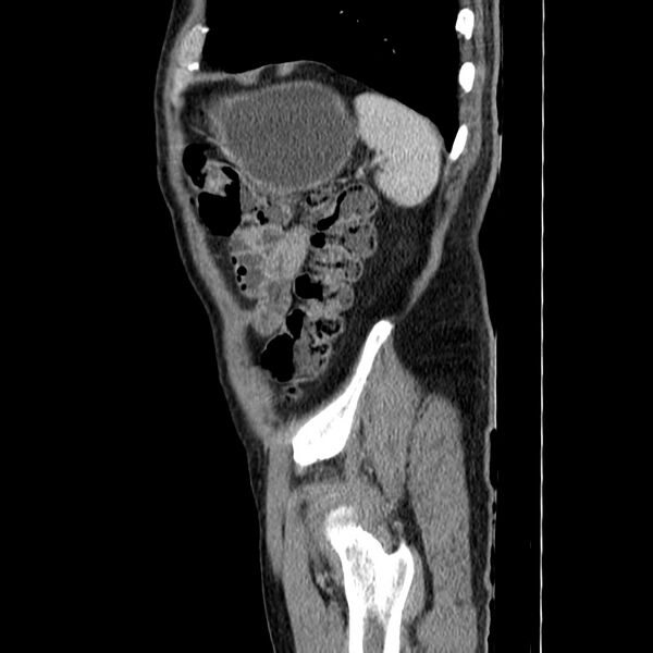 File:Adenocarcinoma of colon with entero-colic fistula (Radiopaedia 22832-22852 Sagittal C+ portal venous phase 56).jpg