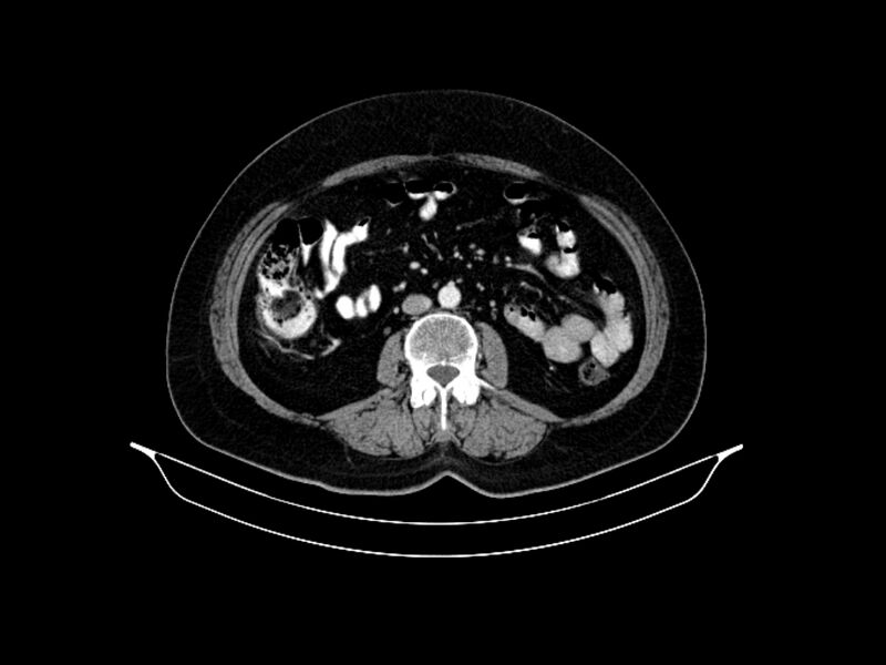 File:Adenocarcinoma of pancreas with hepatic metastasis (Radiopaedia 64332-73122 Axial C+ portal venous phase 55).jpg