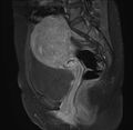 Adenomyosis - ovarian endometriomas (Radiopaedia 67031-76350 Sagittal T1 C+ fat sat 11).jpg