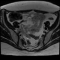 Adenomyosis and endometriotic cysts (Radiopaedia 82300-96367 Axial T2 22).jpg