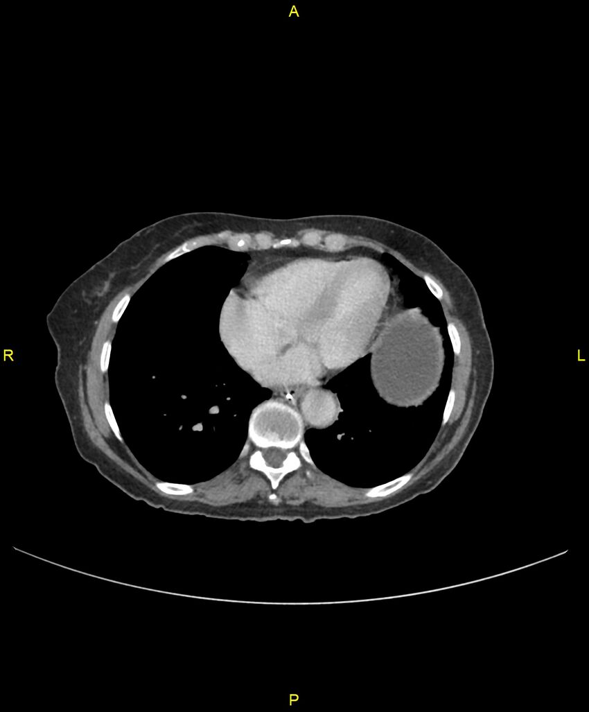 Adhesional small bowel obstruction (Radiopaedia 85402-101024 Axial C+ portal venous phase 8).jpg