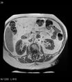 Adrenal myelolipoma (Radiopaedia 6765-7961 Axial T1 in-phase 28).jpg