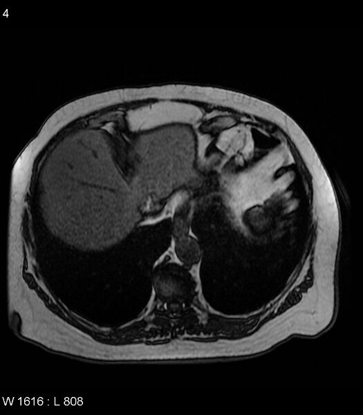 File:Adrenal myelolipoma (Radiopaedia 6765-7961 Axial T1 out-of-phase 4).jpg