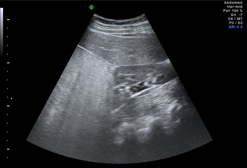 File:Adrenal myelolipoma - bilateral (Radiopaedia 74805-85811 Abdominal ultrasound 8).jpg