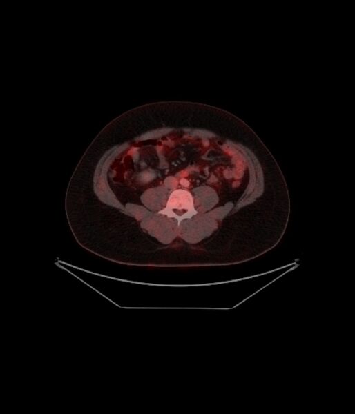 File:Adrenocortical carcinoma (Radiopaedia 80134-93440 ِAxial 200).jpg