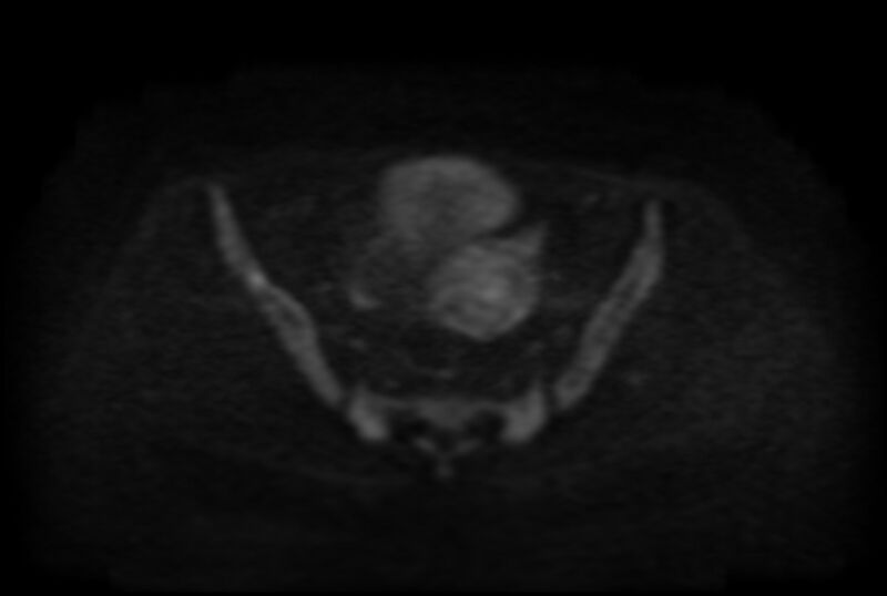 File:Adult granulosa cell tumor of the ovary (Radiopaedia 71581-81950 Axial DWI 12).jpg