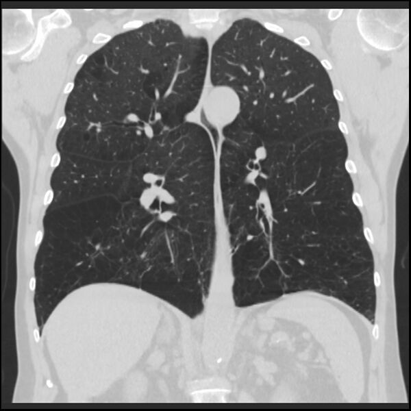File:Alpha-1-antitrypsin deficiency (Radiopaedia 40993-43722 Coronal lung window 61).jpg