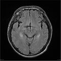 Amnestic syndrome secondary to hypoxic brain injury (Radiopaedia 24743-25004 FLAIR 9).jpg