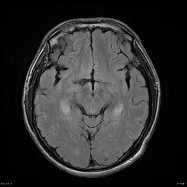 File:Amnestic syndrome secondary to hypoxic brain injury (Radiopaedia 24743-25004 FLAIR 9).jpg