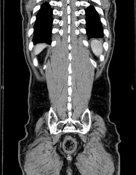 File:Ampullary adenocarcinoma (Radiopaedia 86093-102032 C 61).jpg