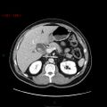 Ampullary carcinoma (Radiopaedia 56396-63056 C 33).jpg