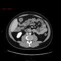 Ampullary carcinoma (Radiopaedia 56396-63056 C 54).jpg