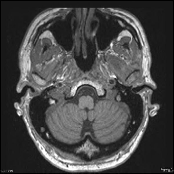 File:Anaplastic meningioma with recurrence (Radiopaedia 34452-35788 Axial T1 13).jpg