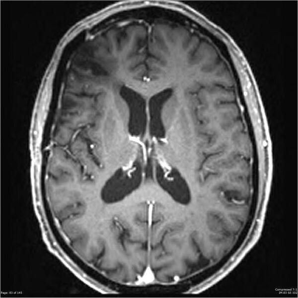 File:Anaplastic meningioma with recurrence (Radiopaedia 34452-35788 Axial T1 C+ 83).jpg