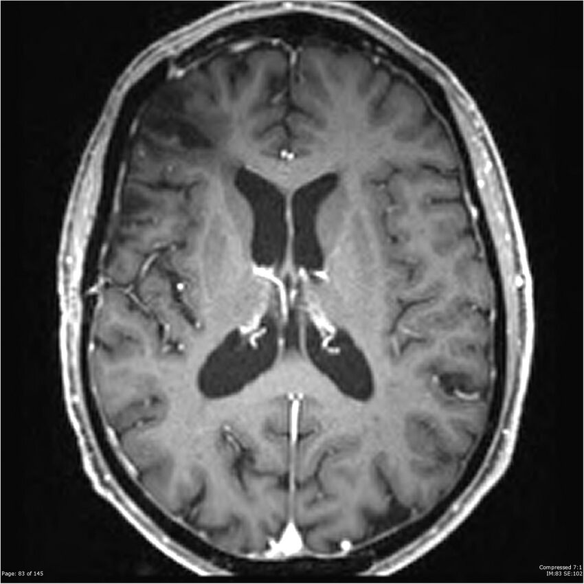 Anaplastic meningioma with recurrence (Radiopaedia 34452-35788 Axial T1 C+ 83).jpg
