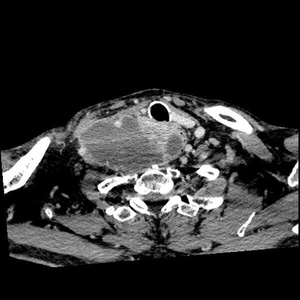 File:Anaplastic thyroid carcinoma (Radiopaedia 79087-92034 B 38).jpg