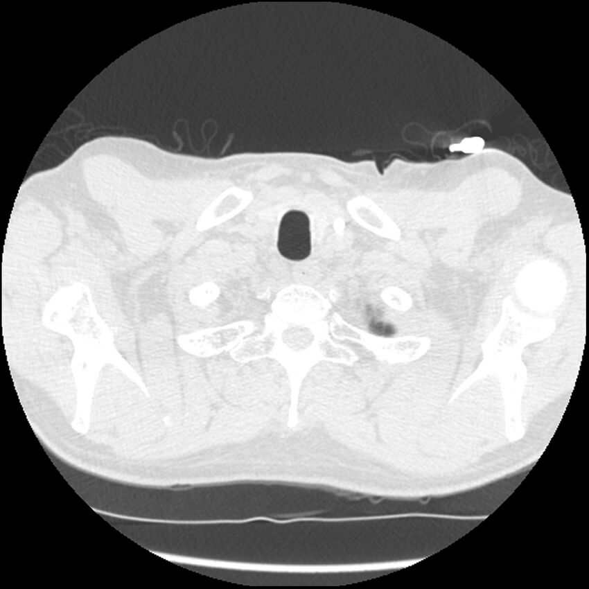 Angioinvasive aspergillosis (Radiopaedia 43957-47466 Axial lung window 6).jpg
