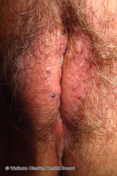File:Angiokeratoma of Fordyce on vulva (DermNet NZ angiokeratoma-25).jpg