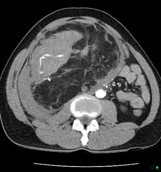 File:Angiomyolipoma (large, hemorrhagic) (Radiopaedia 19228-19241 B 1).jpg