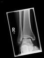 Ankle fracture - Weber A (Radiopaedia 16117).jpg