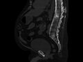 Ankylosing spondylitis (Radiopaedia 44609-48357 Sagittal bone window 58).jpg