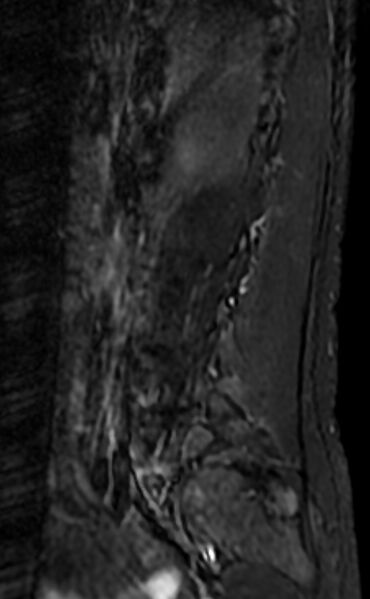 File:Ankylosing spondylitis - Andersson lesion (Radiopaedia 81878-95838 Sagittal STIR 2).jpg
