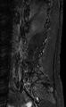 Ankylosing spondylitis - Andersson lesion (Radiopaedia 81878-95838 Sagittal STIR 2).jpg
