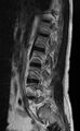 Ankylosing spondylitis - Andersson lesion (Radiopaedia 81878-95838 Sagittal T2 3).jpg