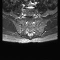 Ankylosing spondylitis with zygapophyseal arthritis (Radiopaedia 38433-40517 D 9).jpg