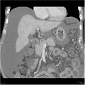 Annular pancreas and cirrhosis (Radiopaedia 24561-24843 B 5).jpg