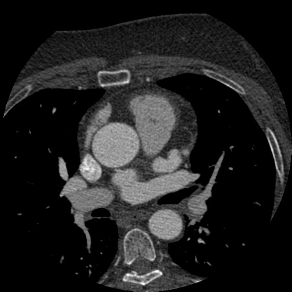 File:Anomalous origin of left circumflex artery from right coronary sinus (Radiopaedia 72563-83117 B 27).jpg