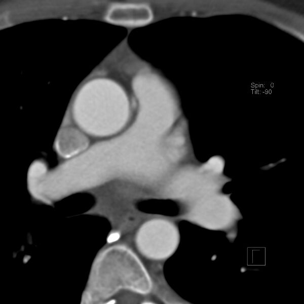 File:Anomalous right coronary artery (ARCA) with interarterial course (Radiopaedia 12423-12677 B 11).jpg