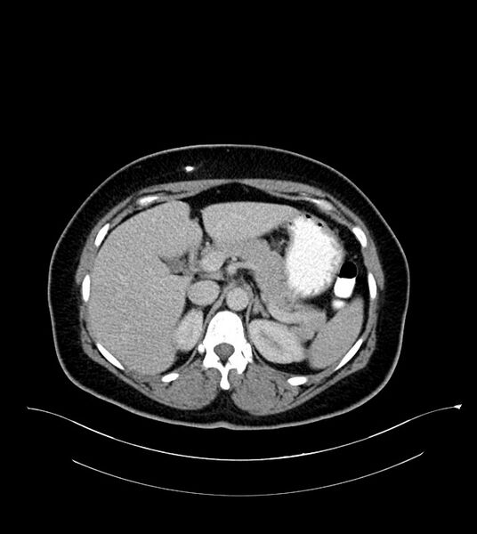 File:Anterior abdominal wall CSF pseudocyst (CSFoma) (Radiopaedia 79453-92571 A 29).jpg