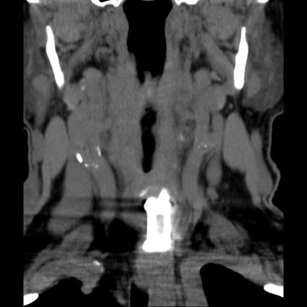 File:Anterior cervical postdiscectomy arthrodesis (Radiopaedia 32678-33646 Coronal non-contrast 5).jpg