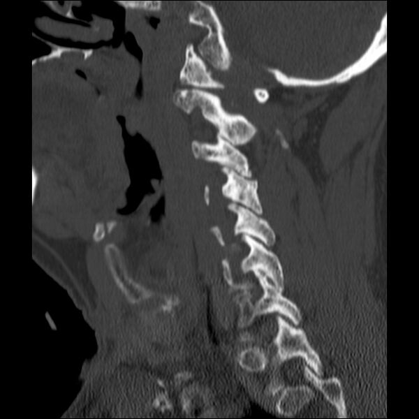 File:Anterior cervical postdiscectomy arthrodesis (Radiopaedia 32678-33646 Sagittal bone window 24).jpg