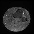 Anterior cruciate ligament tear, Wrisberg rip and bucket-handle tear of medial meniscus (Radiopaedia 75872-87266 Axial PD fat sat 1).jpg