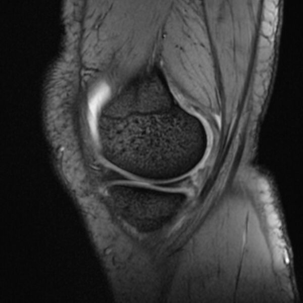 File:Anterior cruciate ligament tear - ramp lesion (Radiopaedia 71883-82322 Sagittal T2 fat sat 20).jpg