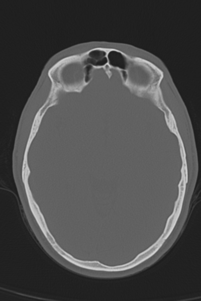 File:Anterior nasal spine fracture (Radiopaedia 46138-50494 Axial bone window 33).png